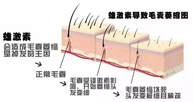 ,脂溢性脱发,