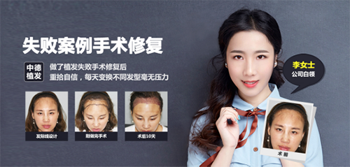 药物,脱发,
